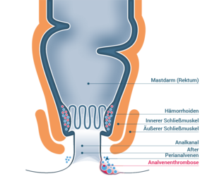 Analvenenthrombose