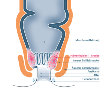 Stadium 1 – Hämorrhoiden I. Grades