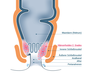 Stadium 2 – Hämorrhoiden II. Grades 