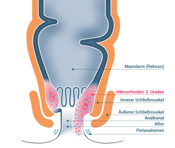 Stadium 3 – Hämorrhoiden III. Grades 