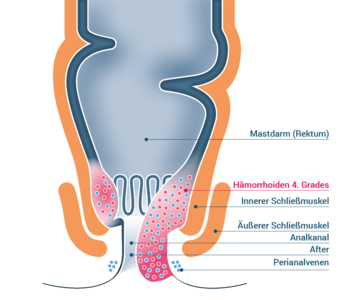 Stadium 4 – Hämorrhoiden IV. Grades