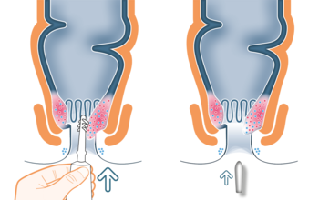 Die Behandlung von Hämorrhoiden